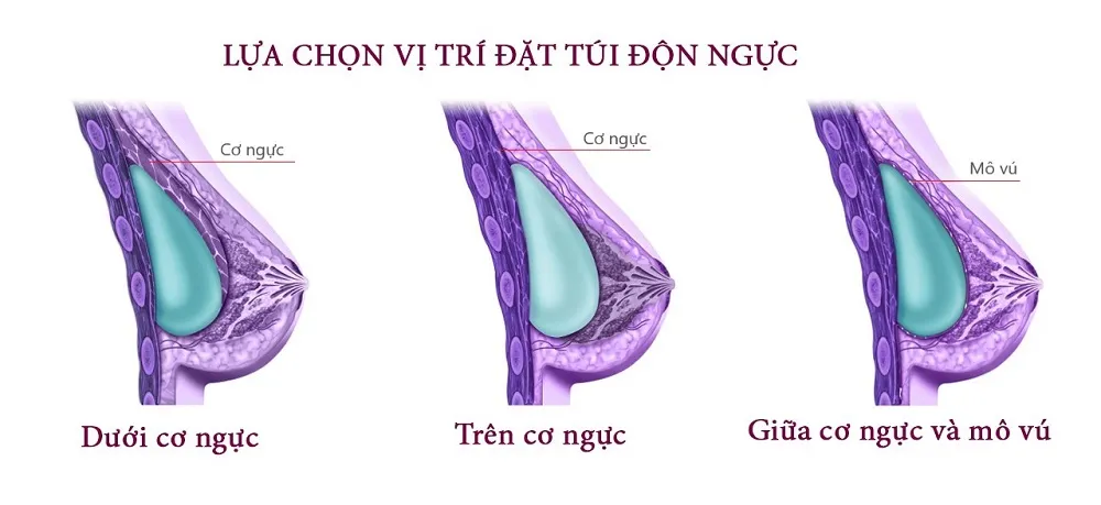 Nên đặt túi độn ngực ở vị trí trên cơ hay dưới cơ