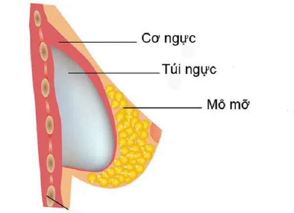 Nên đặt túi độn ngực ở vị trí trên cơ hay dưới cơ