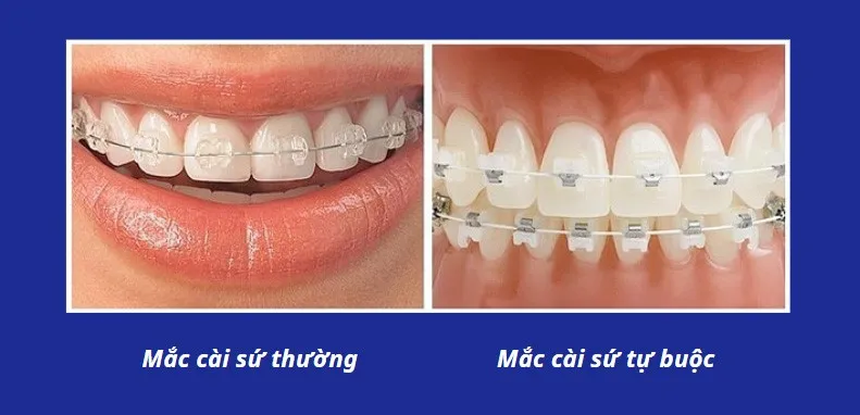 Niềng răng mắc cài sứ là gì? Niềng răng mắc cài sứ có đắt không?