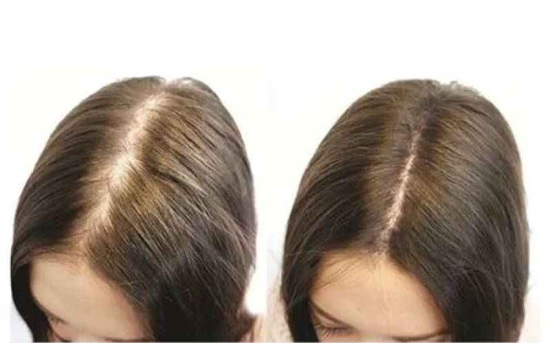 Cấy tóc tự thân FUE có hiệu quả hơn cấy tóc FUT không?
