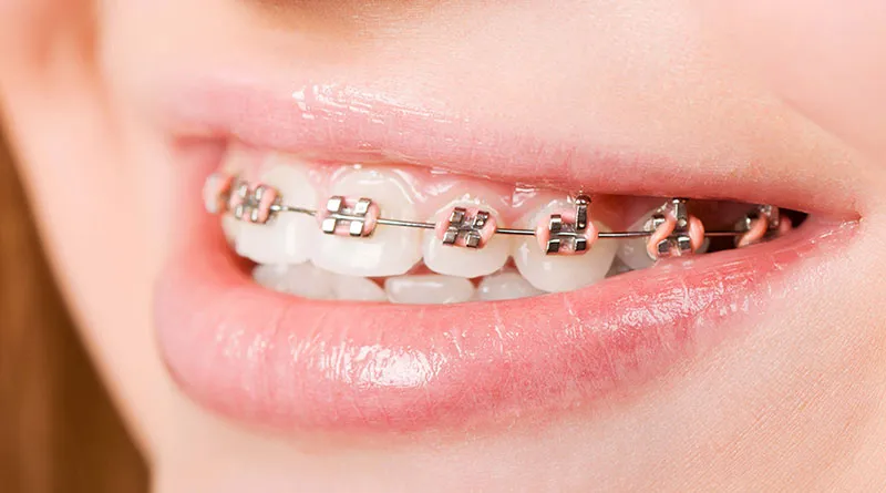 Niềng răng có phải nhổ răng không? Khi nào cần nhổ răng?